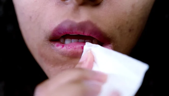 Ensure your lips are clean, dry, and free of makeup, cracks, or inflammation.