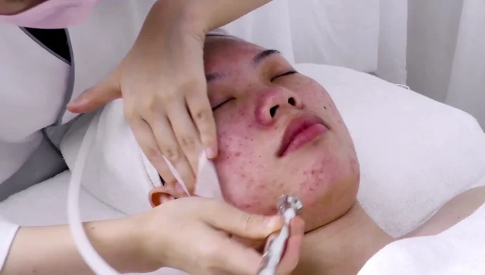 Use flat tube on forehead; use index finger to control suction