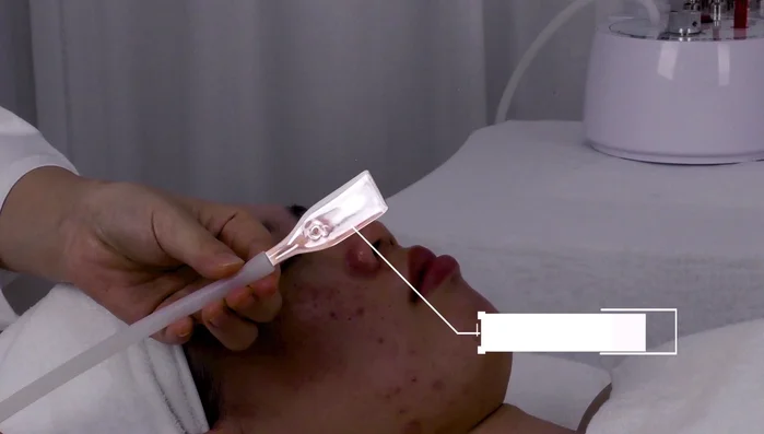 Use flat tube on forehead; use index finger to control suction