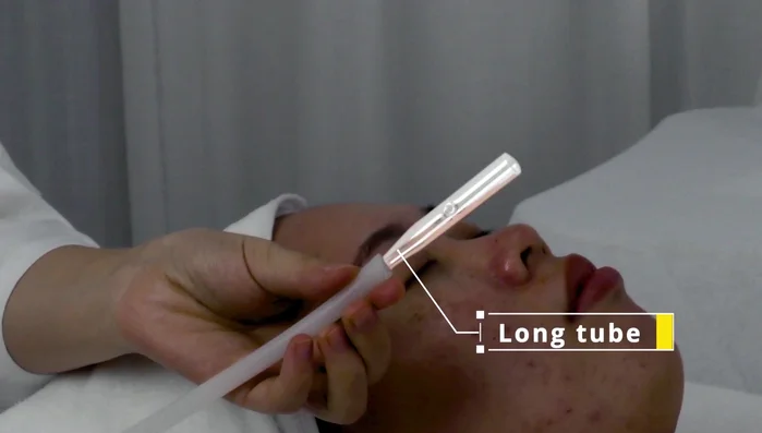 Use curved tube on chin and cheeks