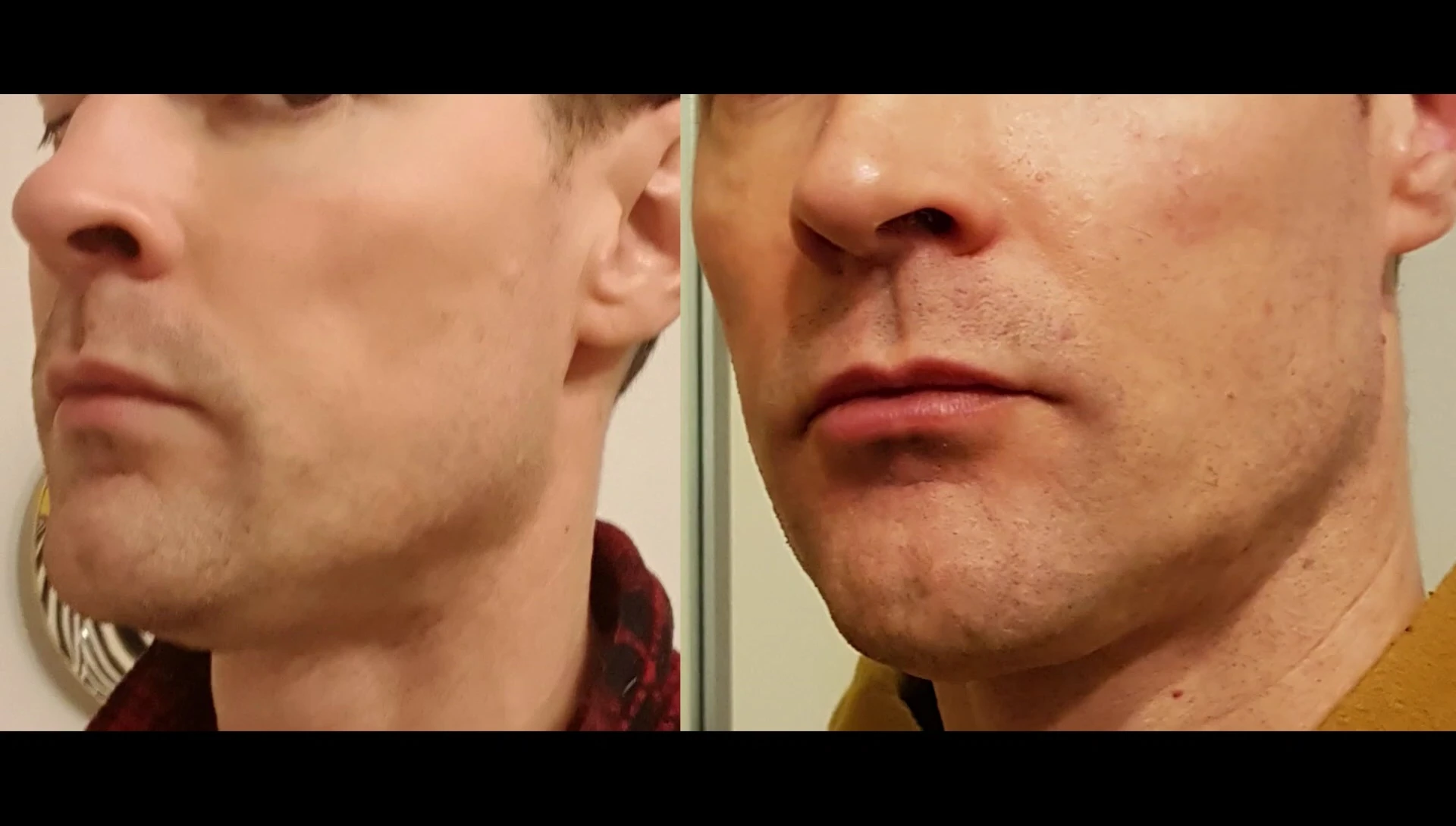 Close-up of the jawline before and after