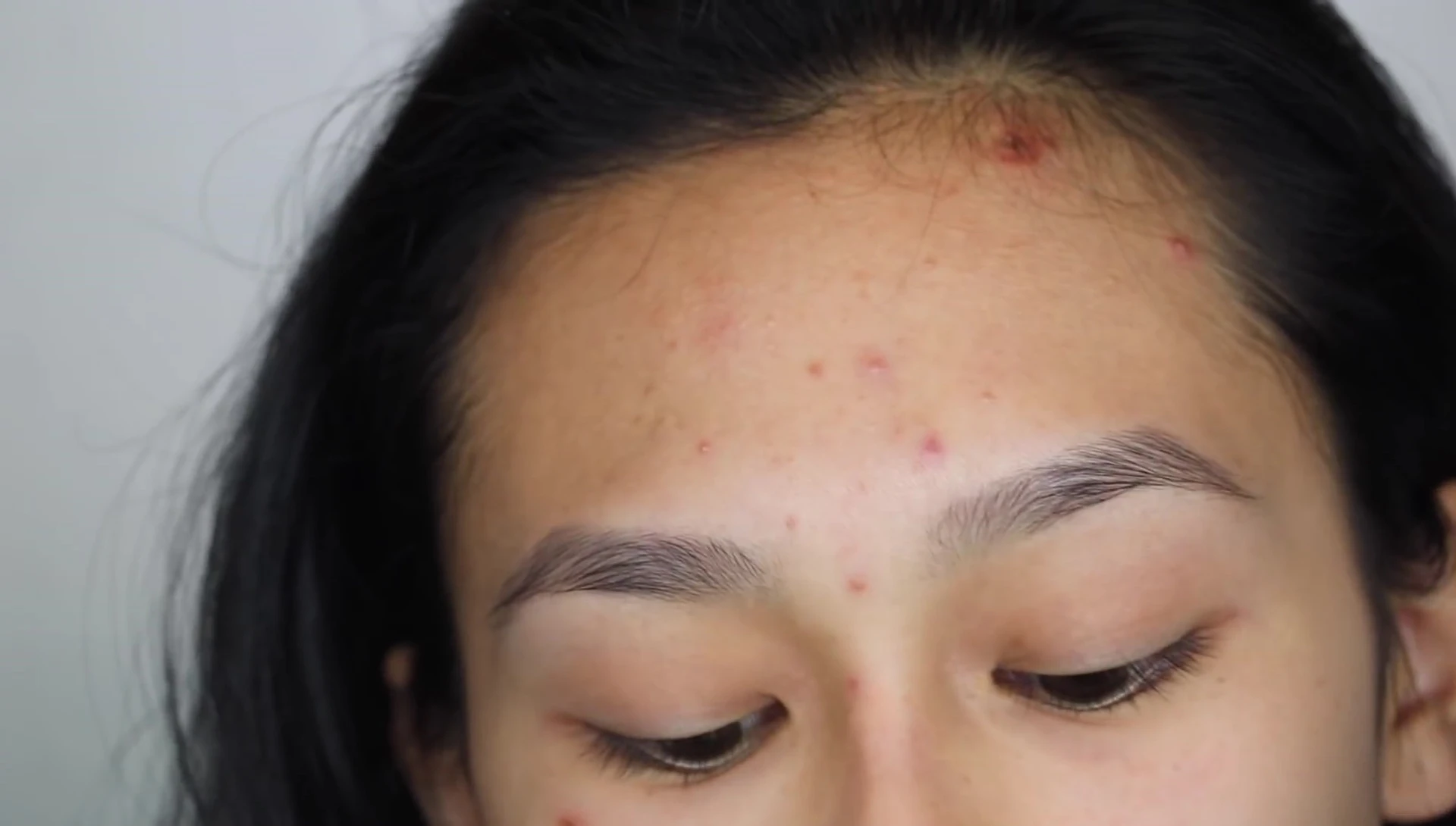 The reviewer is carefully applying a medium-sized patch to a pimple.