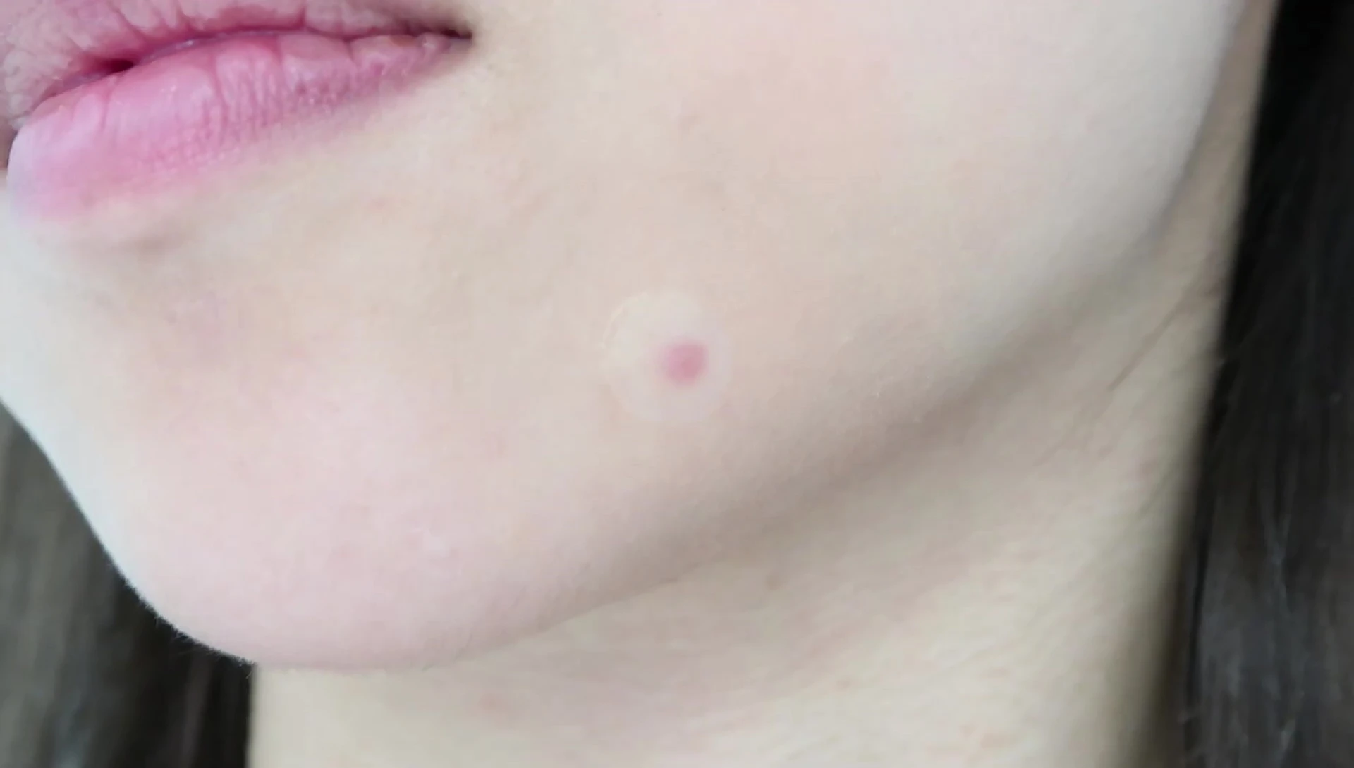 Close-up shot of the pimple after the blemish dot was removed.