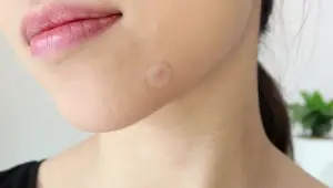 Skin Iceland Blemish Dots Review: Do They Really Work?