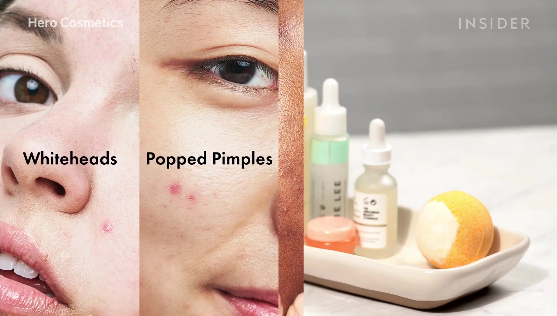 Image showing examples of superficial inflammatory acne