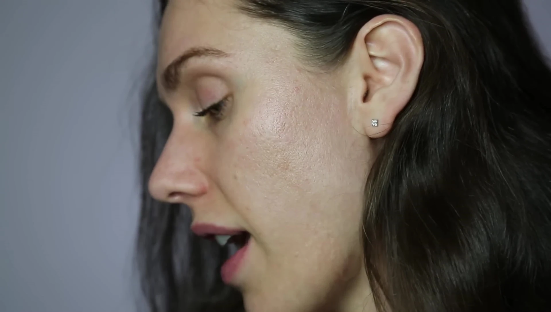 The area of skin after the patch has been removed