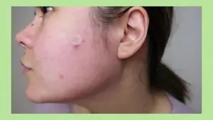 Cosrx Acne Patches: Pimple Master vs Clear Fit Master Patch Review