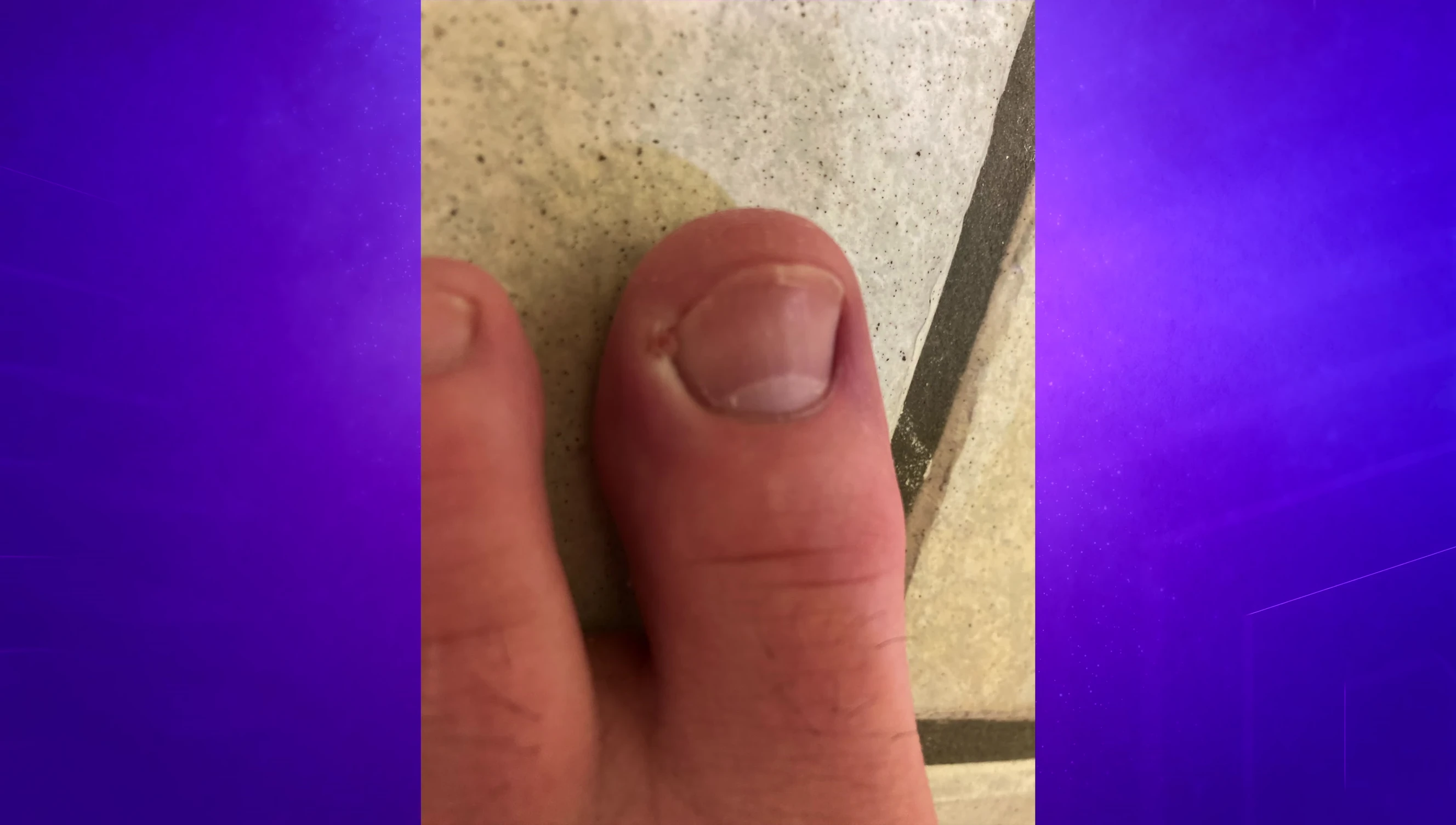 Image showcasing the use of the patch on an ingrown toenail.