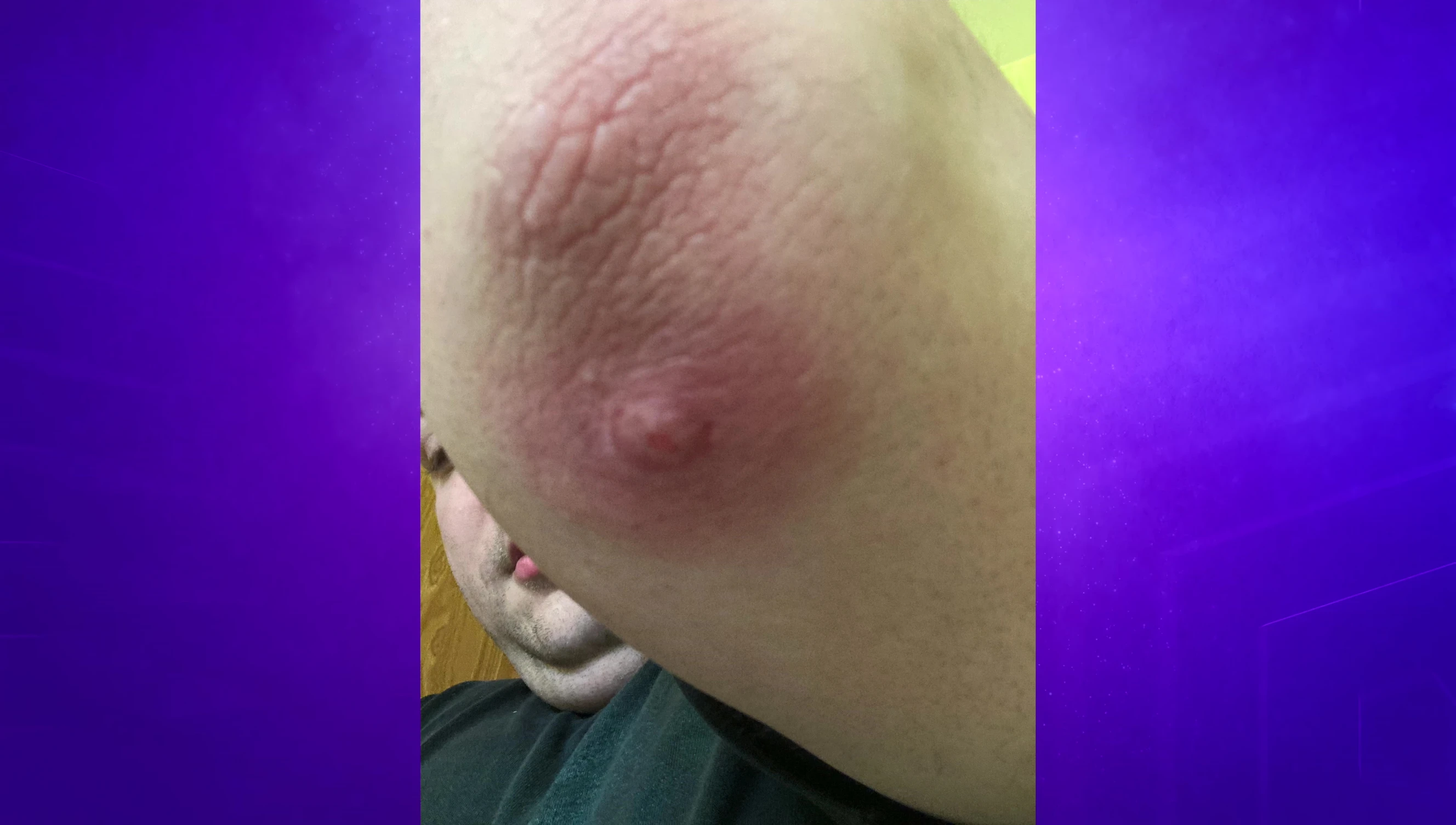 Person demonstrating the application of the Mighty Patch.