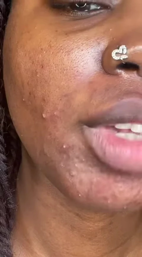 Close-up shot of the skin after removing patches.