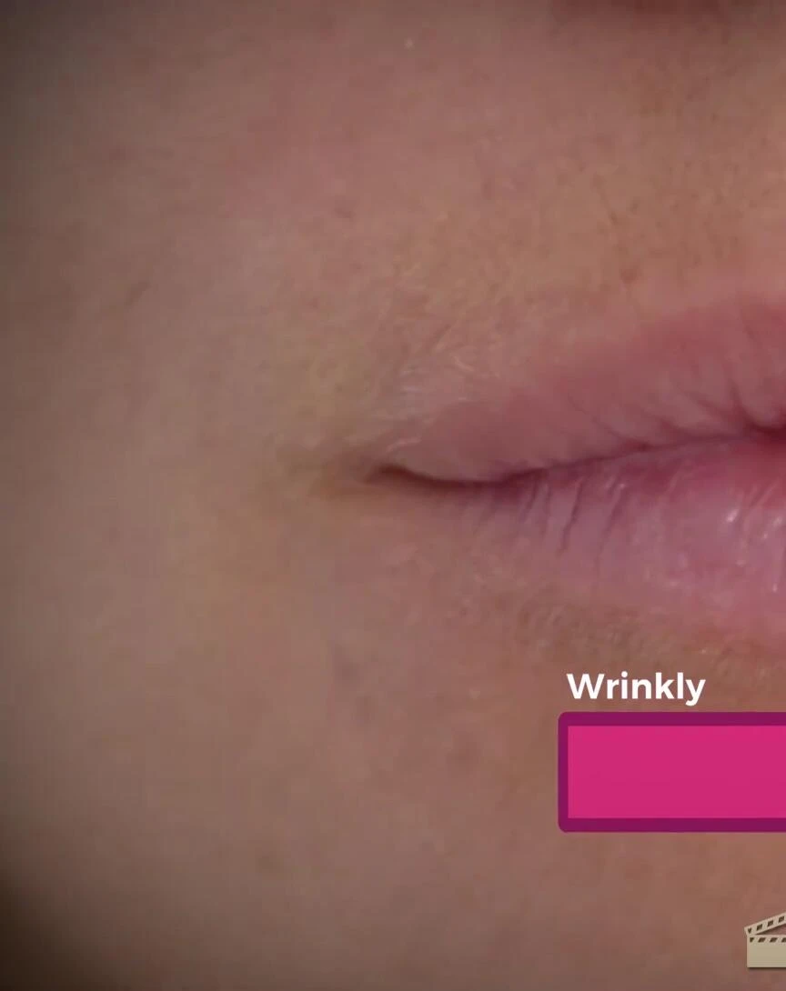 Before and after images showcasing lip enhancement.