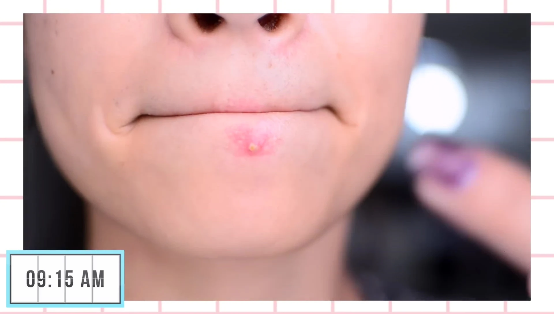 Close-up of a pimple on the speaker's face.