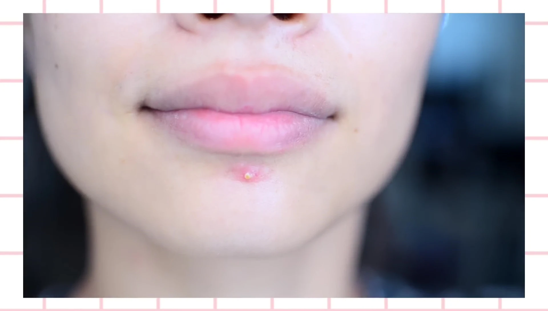 Close-up shot of a large, inflamed pimple.