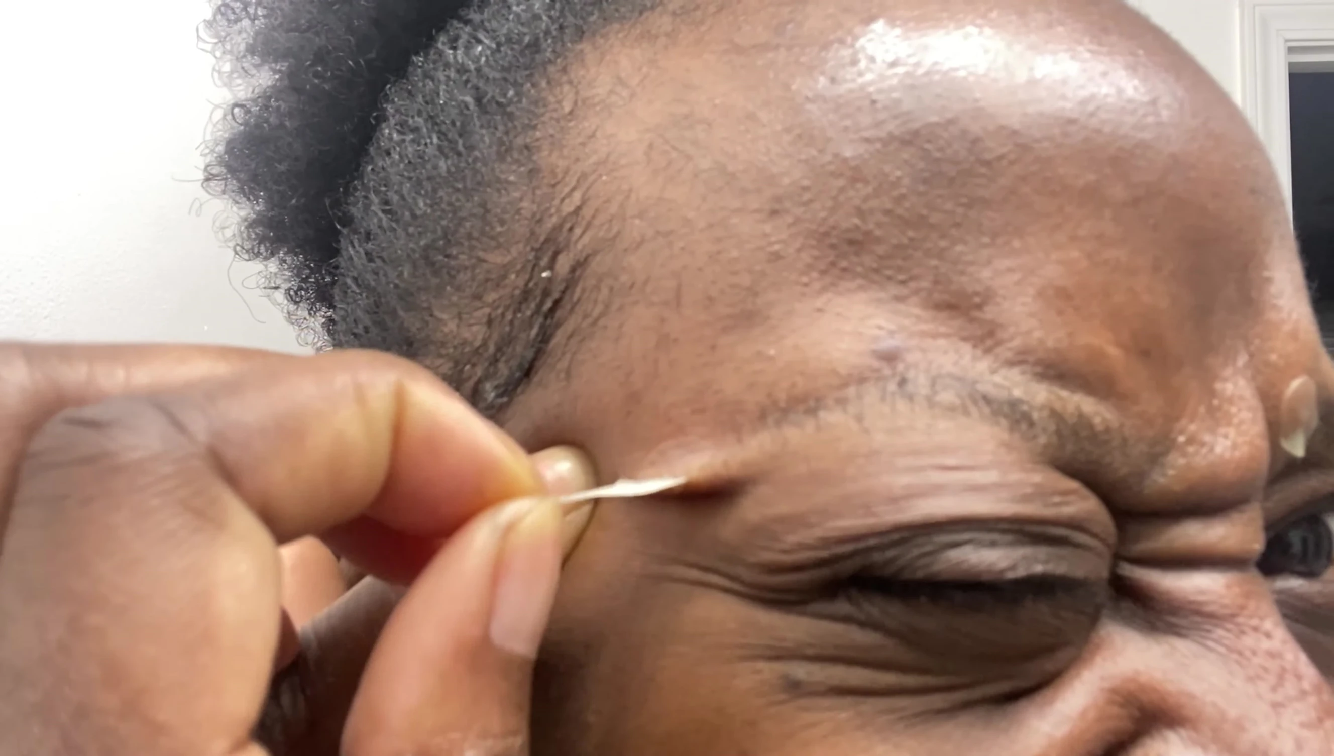 Removing a pimple patch, showing some pus and hair removal.