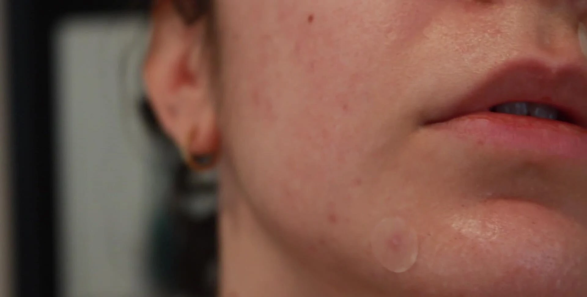 The hydrocolloid patch after a night of use, showing the absorbed fluid.