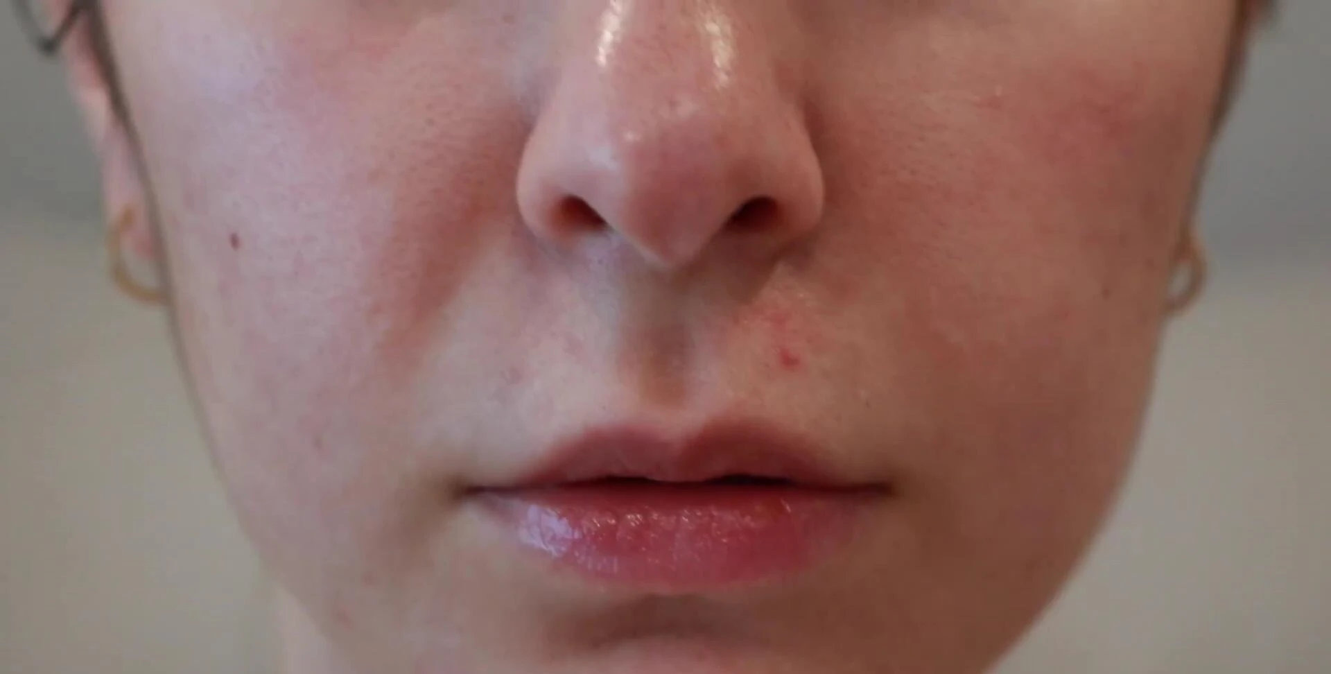 Applying hydrocolloid patches during the daytime.