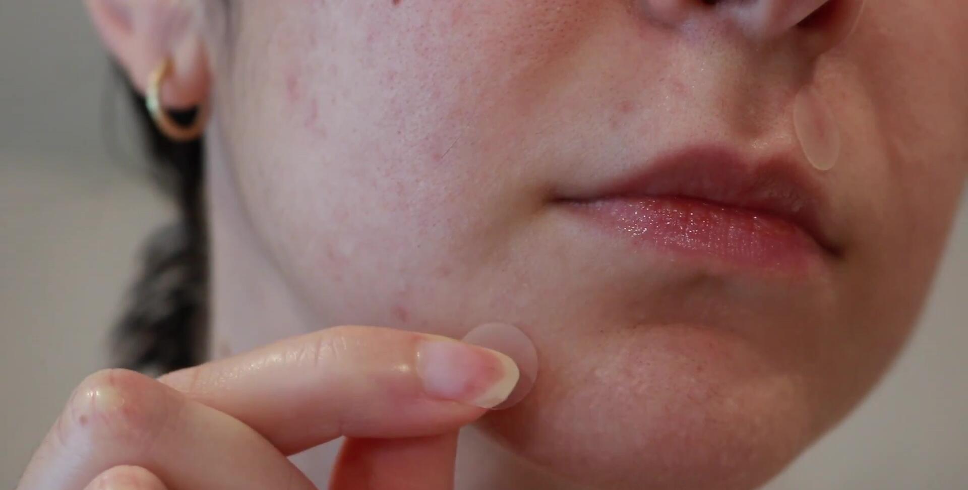 The pimple after daytime use of the hydrocolloid patches, showing reduction in size and redness.