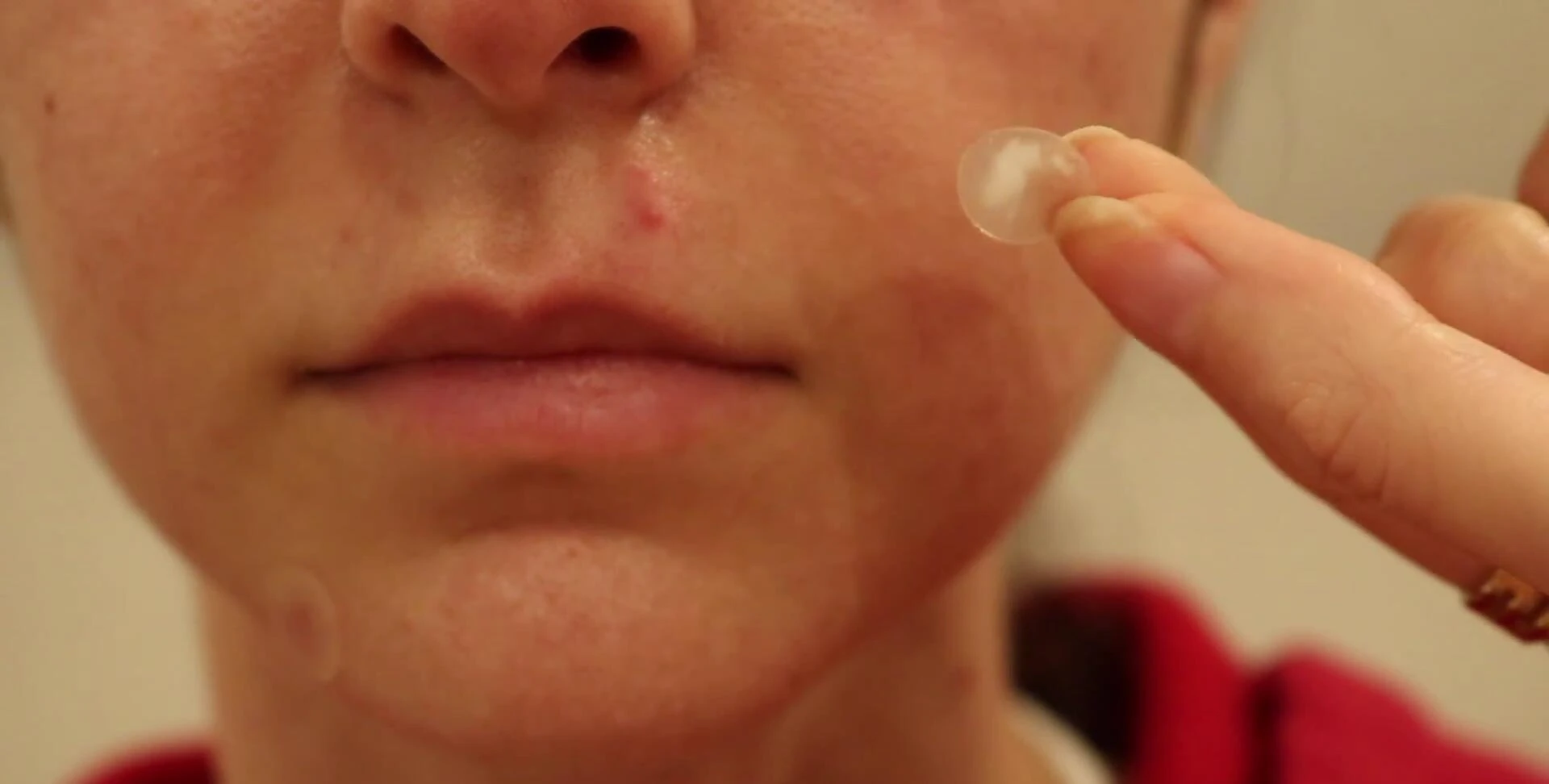 Close-up of a used hydrocolloid patch, demonstrating the absorbed fluid.