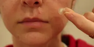 Hydrocolloid Patches for Pimples: Overnight Miracle or Hype?