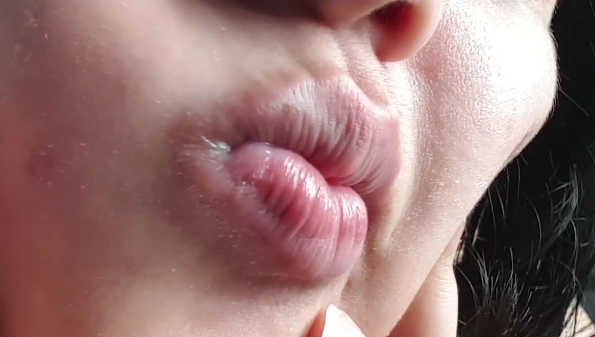 Demo on the chin showing partially removed hair.