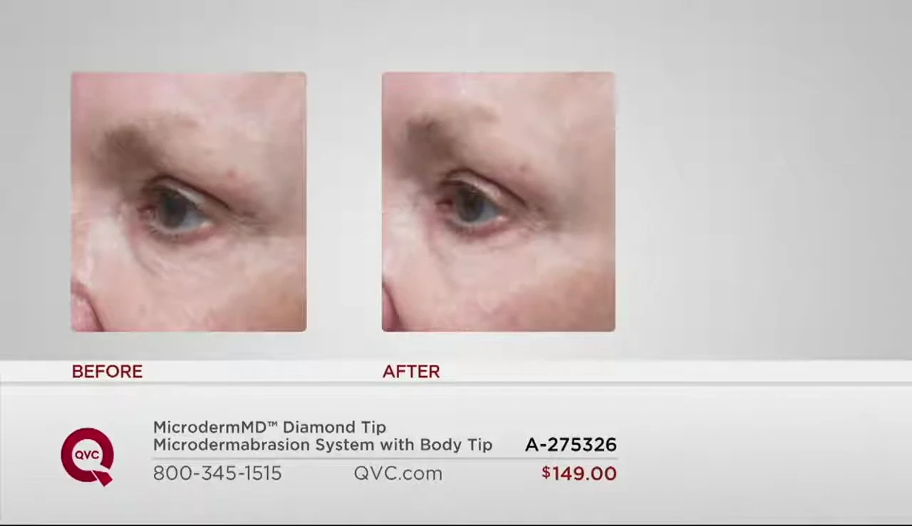 Before and after pictures showcasing the improvement in skin texture and reduction of fine lines.