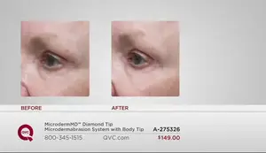 MicrodermMD Review: At-Home Microdermabrasion System