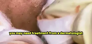 Extreme Pore Cleaning: A Deep Dive into Acne Treatment